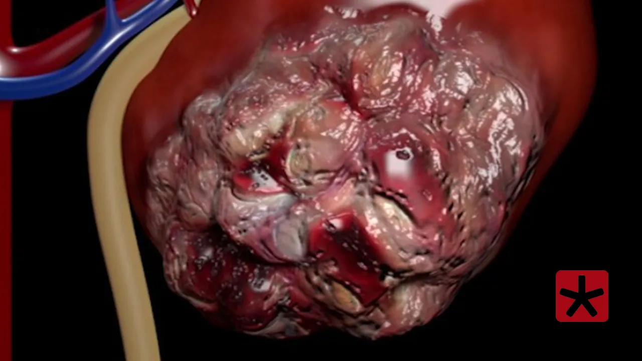 Dados de 2014 a 2023 mostram alta recente nas mortes e crescimento da incidência em faixas etárias mais jovens.