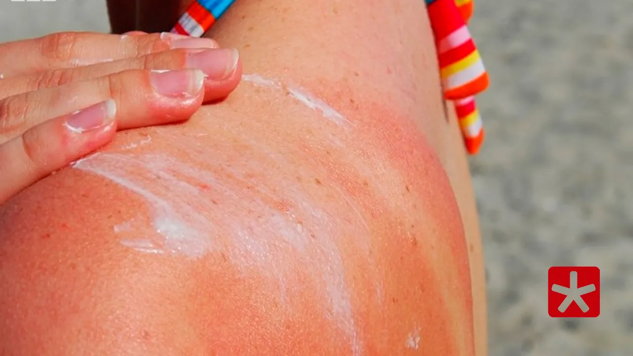 Até dezembro deste ano, cerca de 3.512 casos de câncer de pele foram registrados